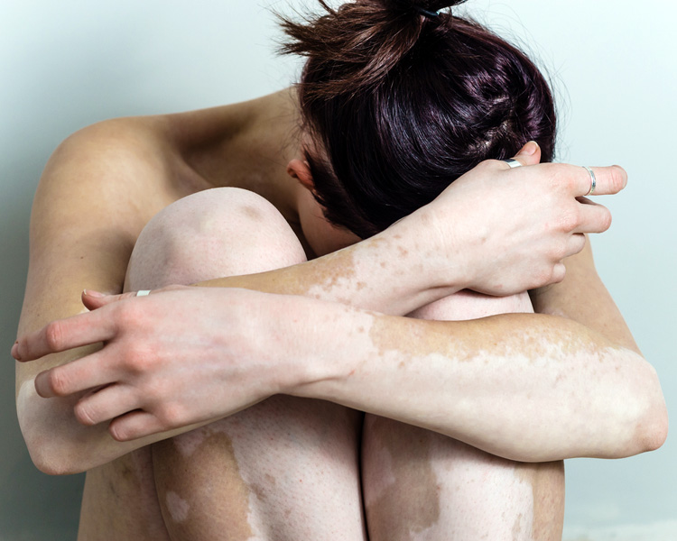 dermatolog-leczenie-bielactwo