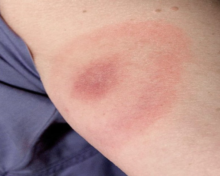 dermatolog-leczenie-borelioza