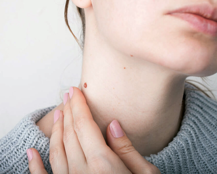 dermatolog-leczenie-brodawki