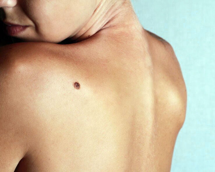 dermatolog-leczenie-czerniak