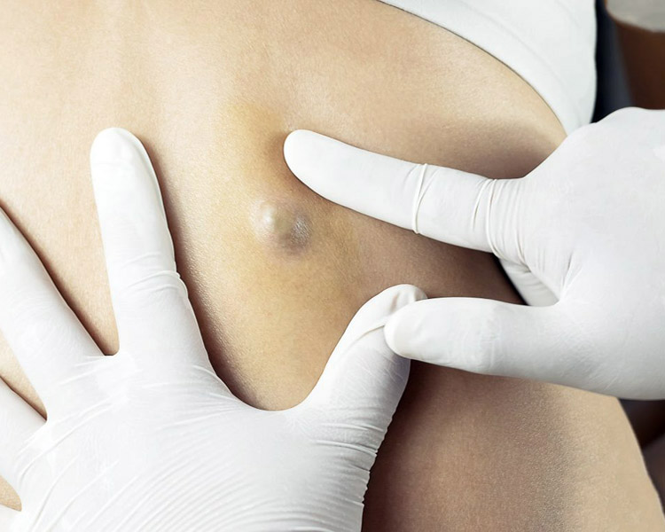dermatolog-leczenie-kaszaki