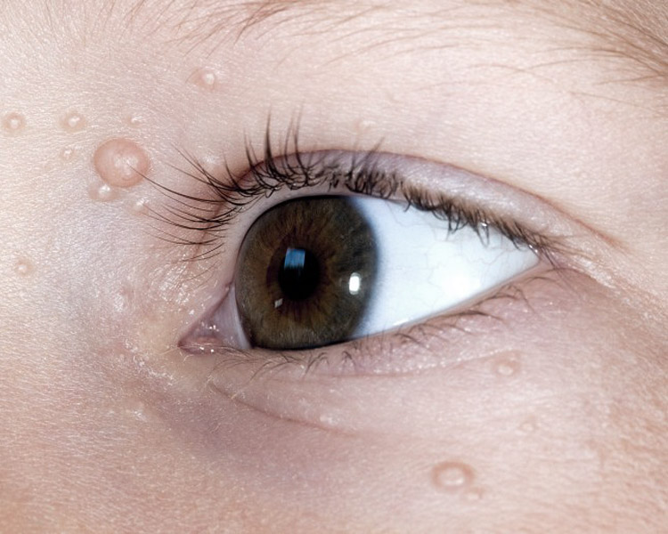 dermatolog-leczenie-mieczak-zakazny