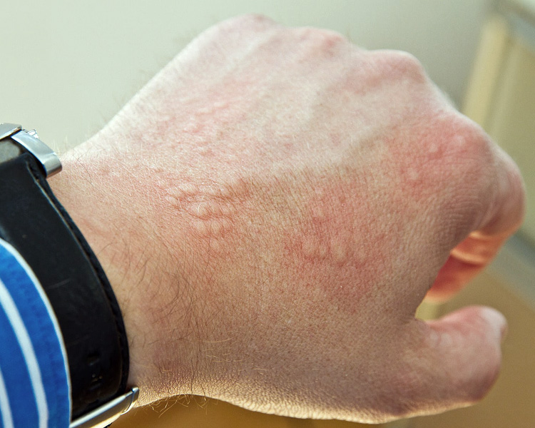 dermatolog-leczenie-pokrzywka dermatolog-leczenie-pokrzywka
