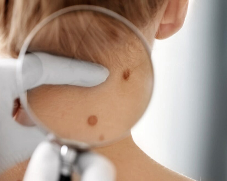 dermatolog-leczenie-rak-skory