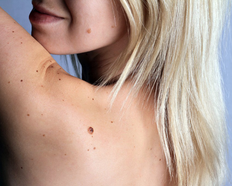 dermatolog-leczenie-wlokniaki dermatolog-leczenie-wlokniaki