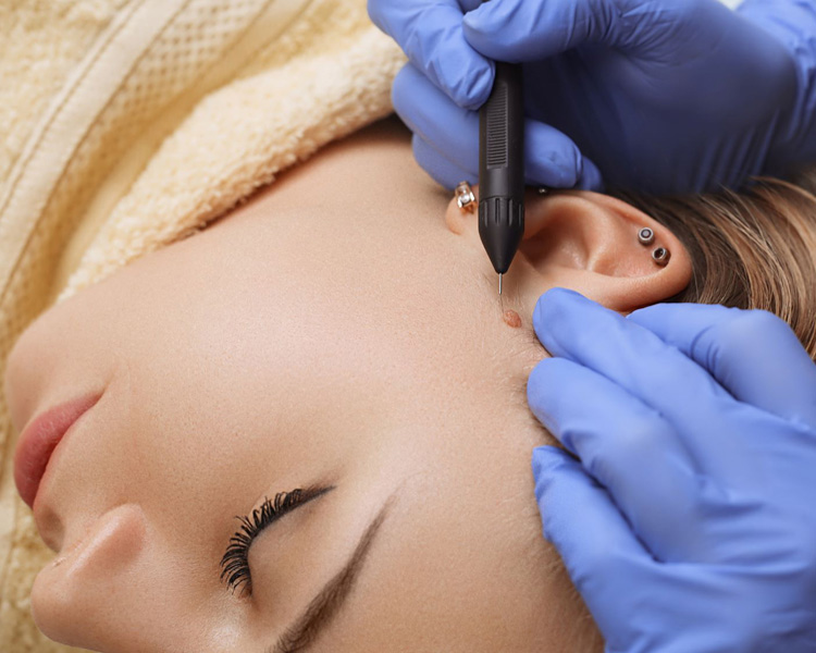 dermatolog-zabiegi-elektrochirurgia-1 dermatolog-zabiegi-elektrochirurgia-1