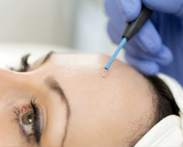 dermatolog-zabiegi-elektrochirurgia-2 dermatolog-zabiegi-elektrochirurgia-2